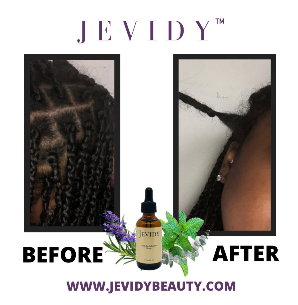 Jevidy Scalp Revitalization Drops for hair growth, moisture and length retention