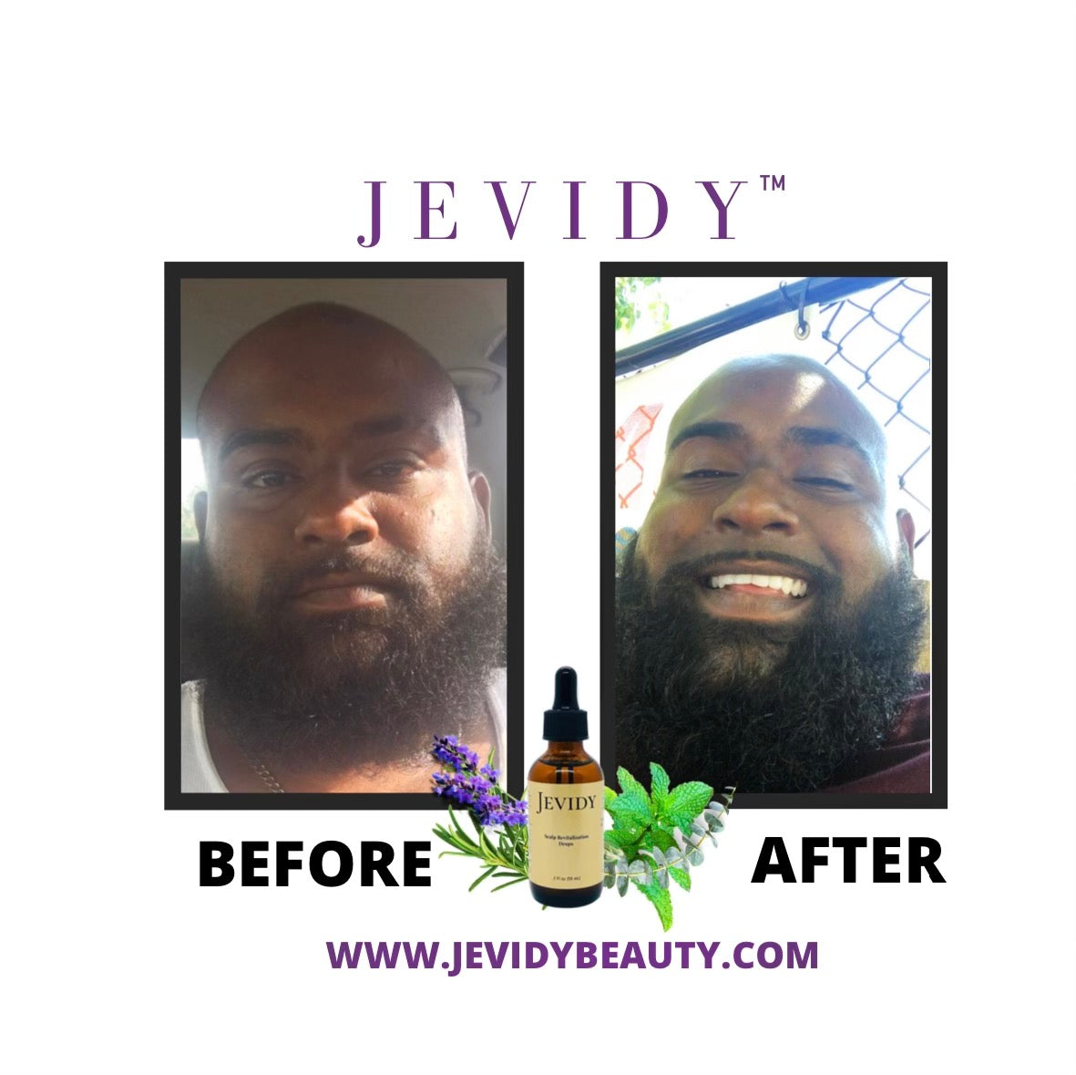 Jevidy Scalp Revitalization Drops for hair growth, moisture and length retention for beards